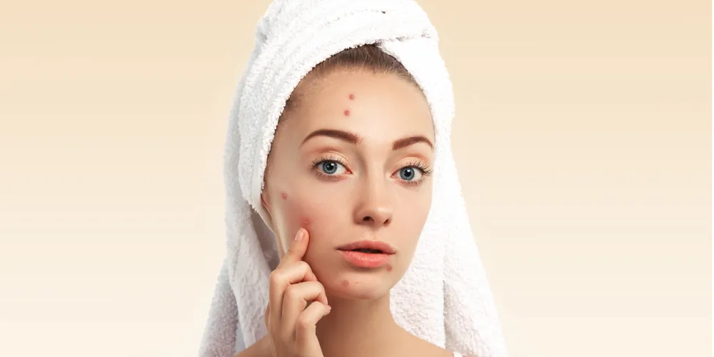 Femme observant ses imperfections et boutons d’acné sur le visage, après la douche, avec une serviette blanche enroulée autour de la tête.
