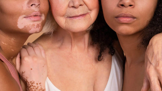 Qu'est-ce qui provoque l'hyperpigmentation ? - Holy Skin