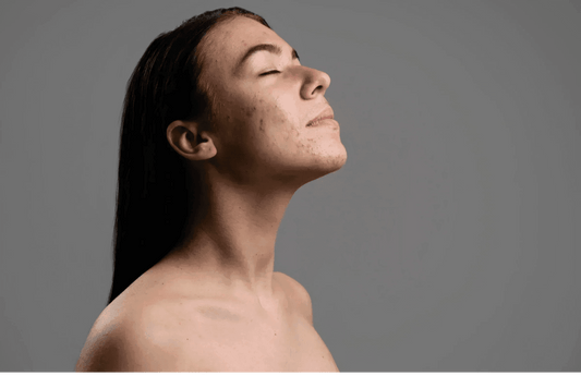 Comment éliminer les points noirs en moins de 5 minutes ? ⏰ - Holy Skin