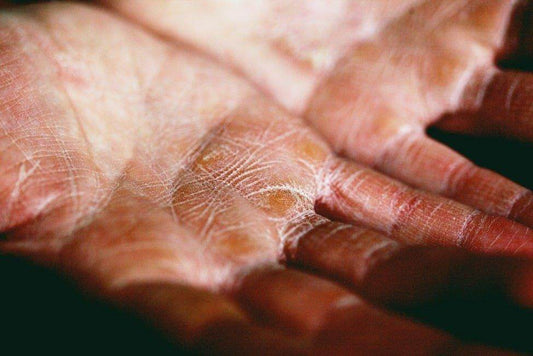 Peau Sèche : Adieu la Peau qui Démange ! - Holy Skin